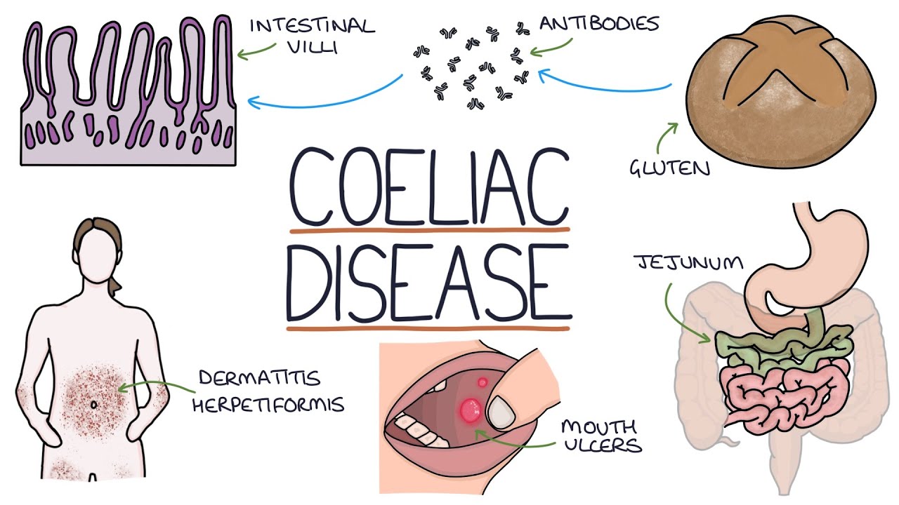 celiac sprue disease